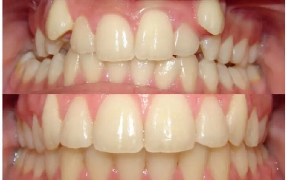 Sebelum dan selepas rawatan braces, kes pesakit Mygigi